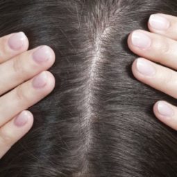 Itchy scalp: Close up of a woman's scalp and brown hair