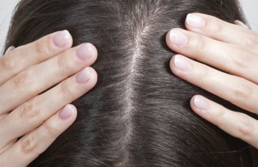 Itchy scalp: Close up of a woman's scalp and brown hair