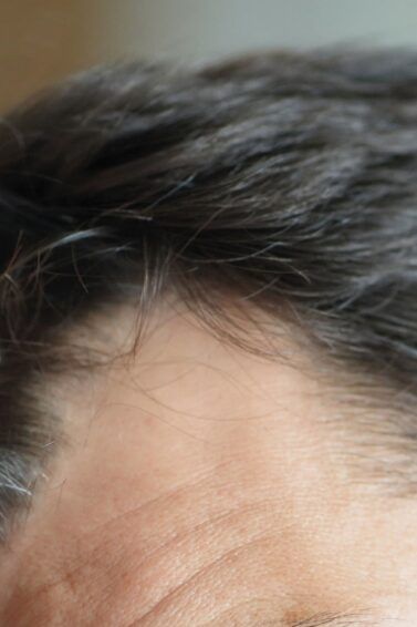 Hombre con alopecia androgénica y entradas en el cabello
