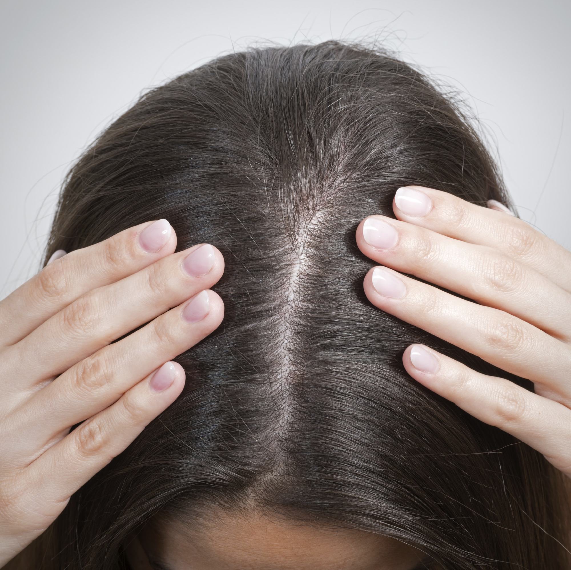 Lice vs Dandruff - How to Tell Difference Between Lice & Dandruff